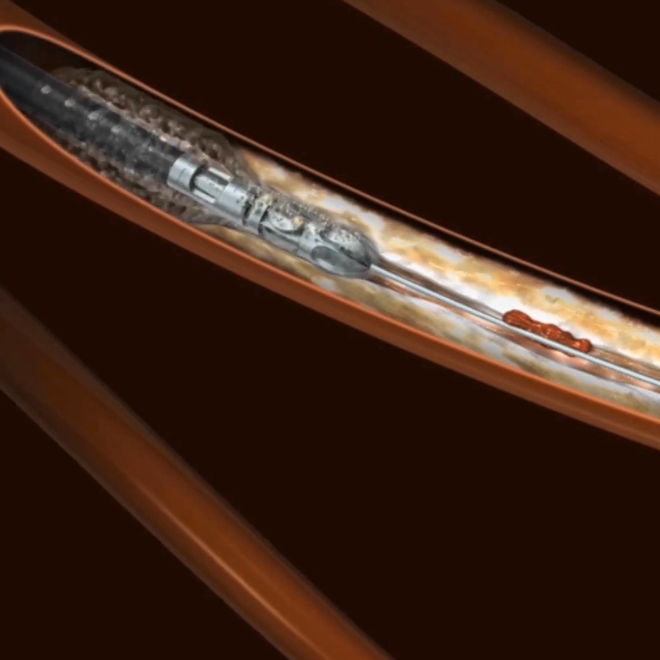 Jetstream Atherectomy Mechanism of Action animation