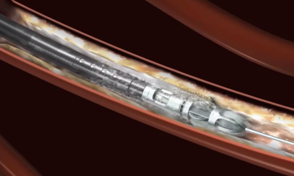 Jetstream Atherectomy Mechanism of Action animation